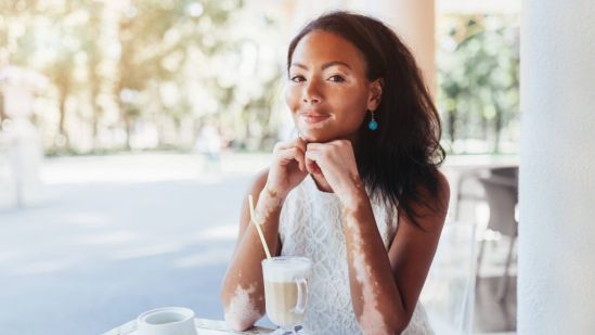 Vitiligo, cuando las células que producen melanina mueren o dejan de producirla