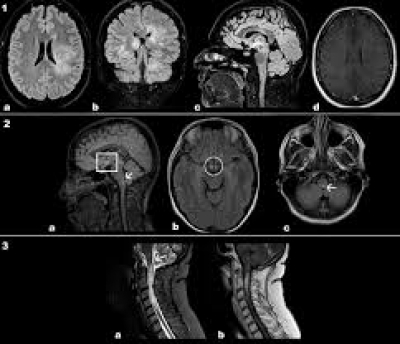 DOPAMINA: la bioquímica del amor, los neurotransmisores que nos hacen sentir enamorados