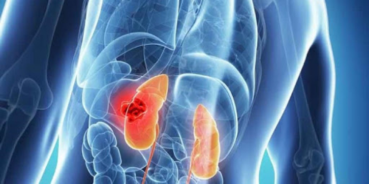 Dapagliflozina, primer medicamento que prolonga significativamente la supervivencia en un ensayo clínico realizado en esta población de pacientes